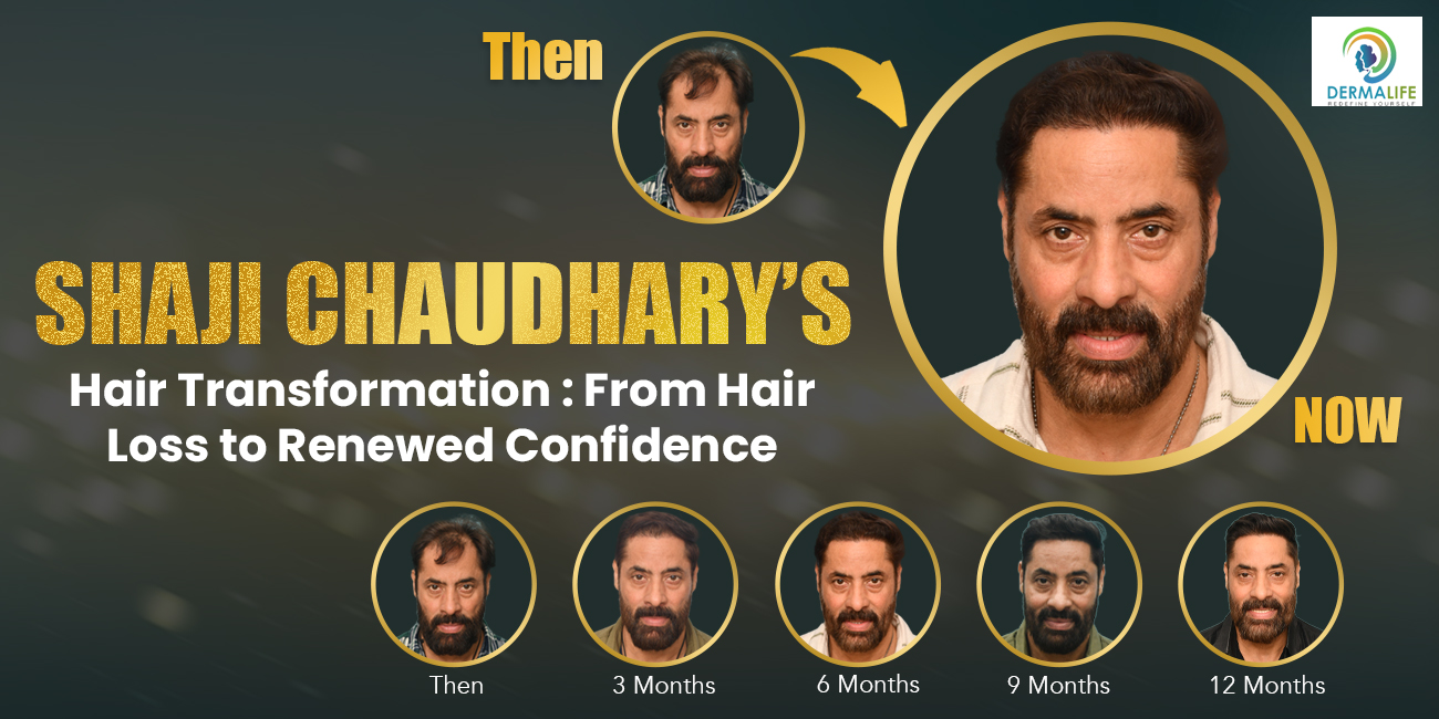 Why Hair Transplants Are the #1 Solution for Permanent Hair Loss