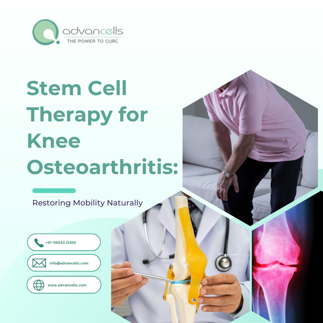 Stem Cell Therapy for Knee Osteoarthritis: Restoring Mobility Naturally