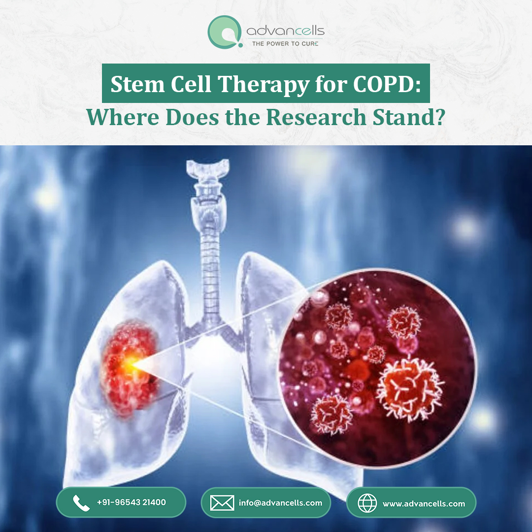 Stem Cell Therapy for COPD: Where Does the Research Stand?