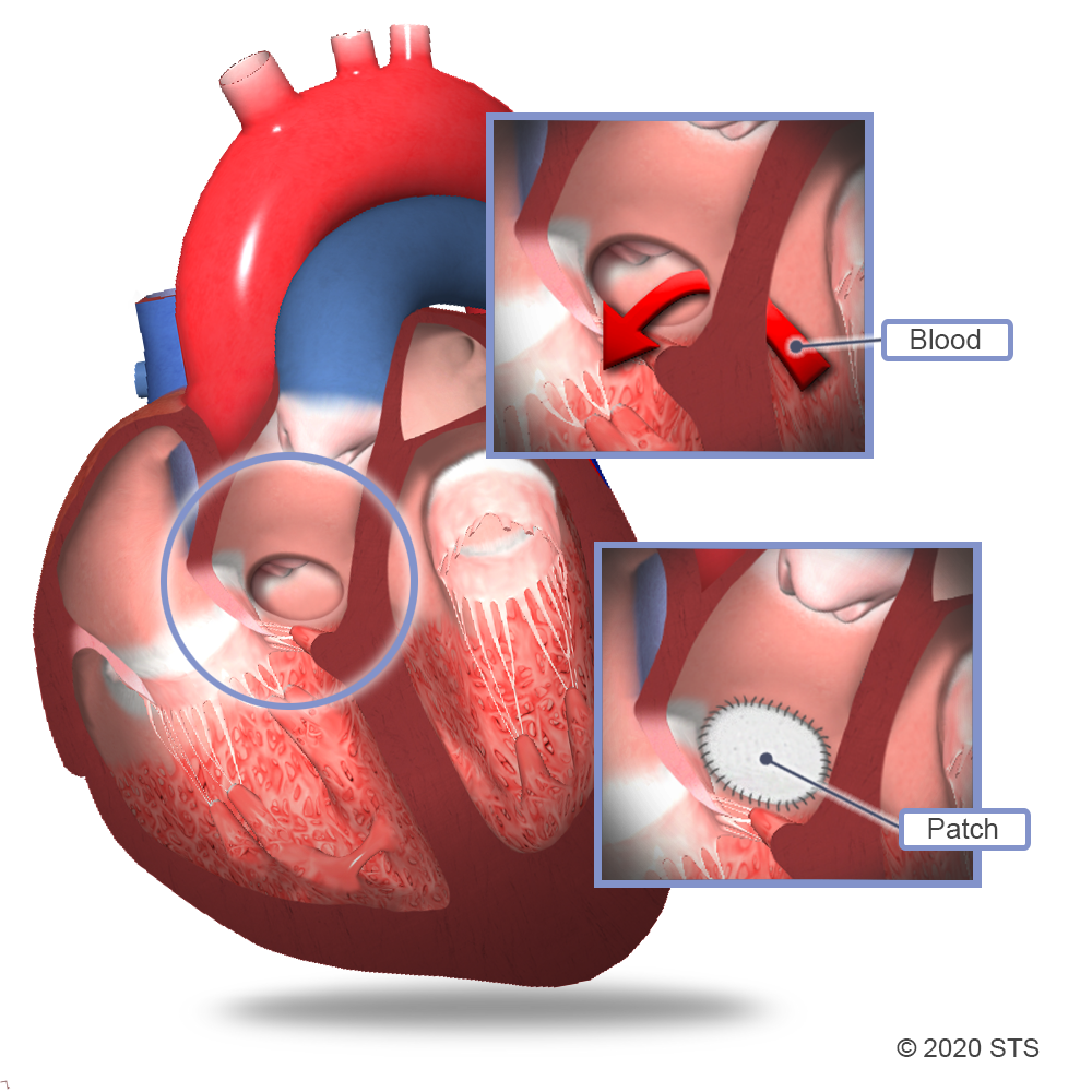 Advanced Heart Hole Defect Treatment in Jaipur