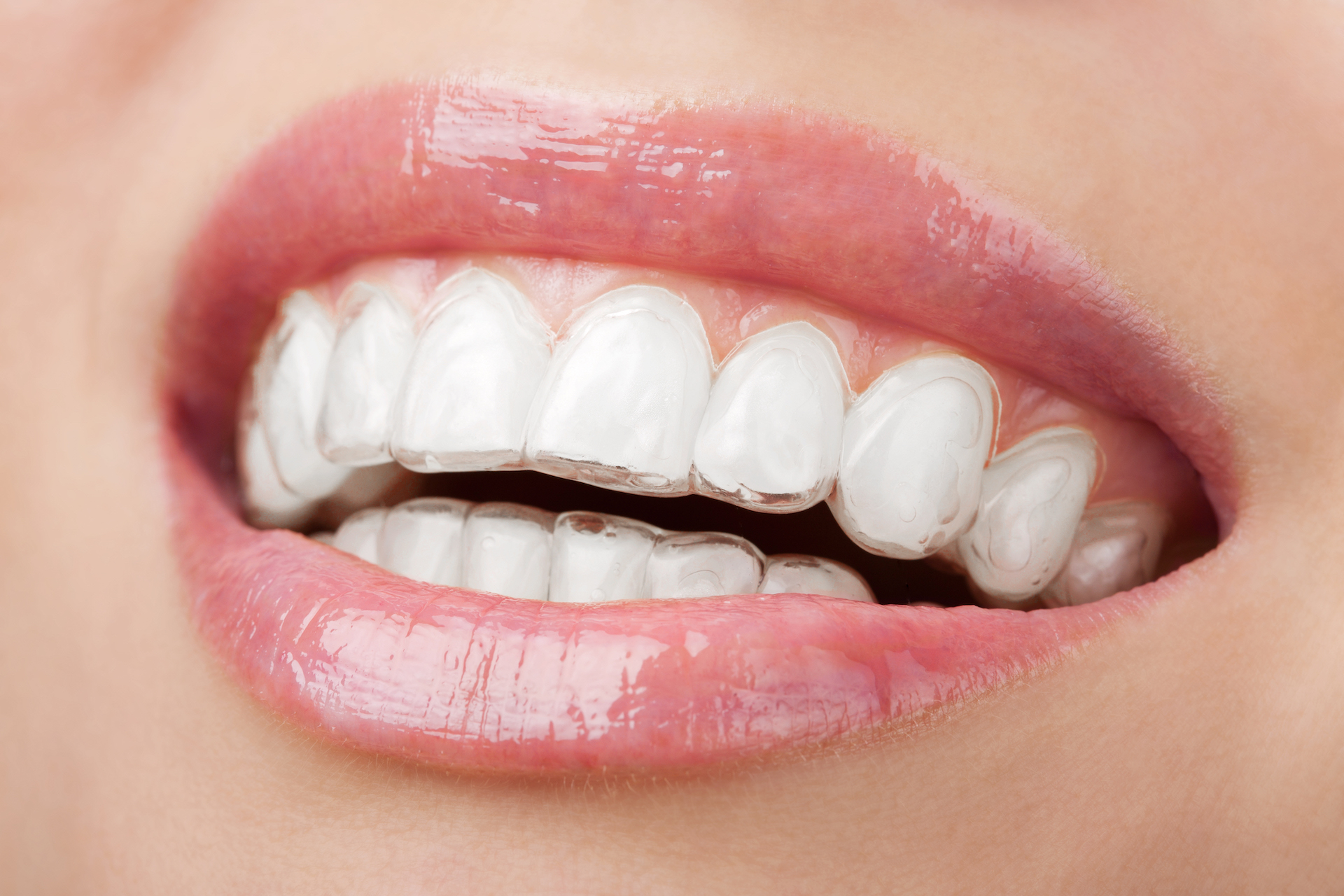Choosing Quality: A Guide to Dental Implants in Chennai