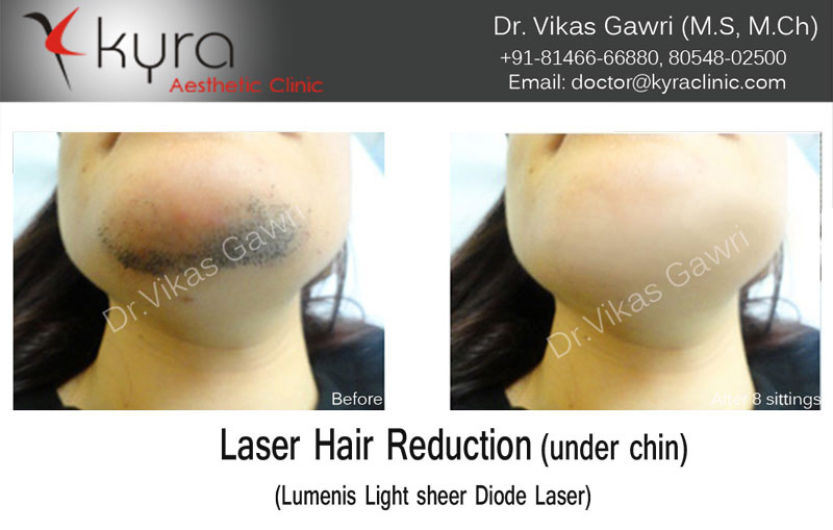 Experience Smooth, Hair-Free Skin with Laser Hair Removal in Punjab at Kyra Clinic