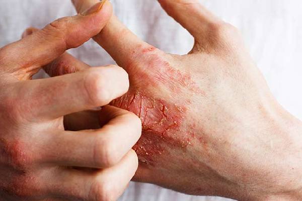 Trusted Legal Help for Occupational Dermatitis Claims in Bolton